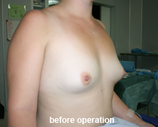 plastic-surgery-breast-augmentation